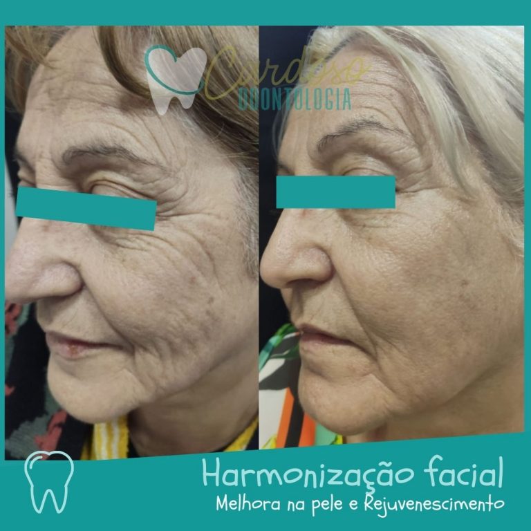 tratamento harmonização facial - Cardoso Odontologia