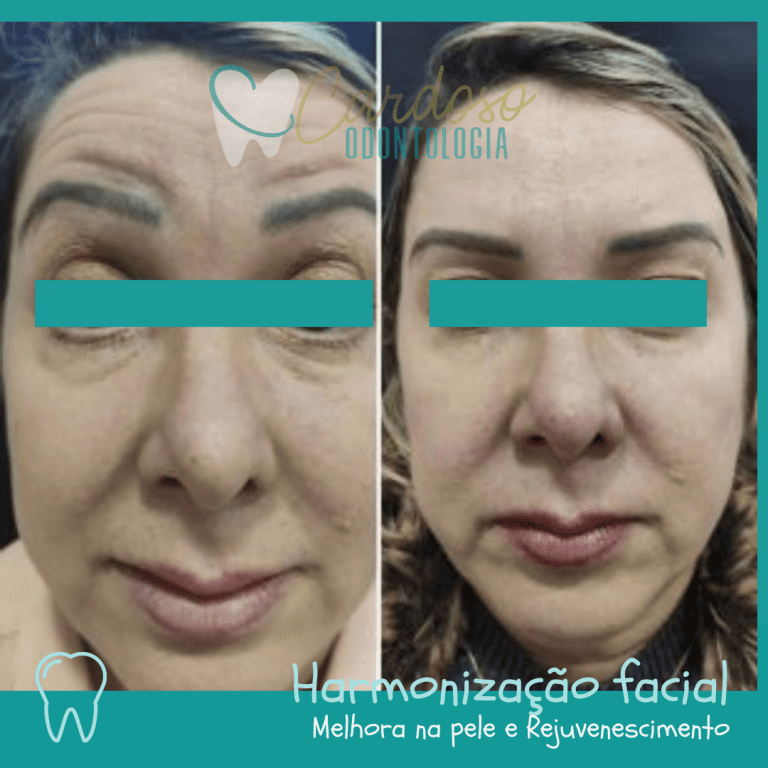 tratamento harmonização facial- Cardoso Odontologia