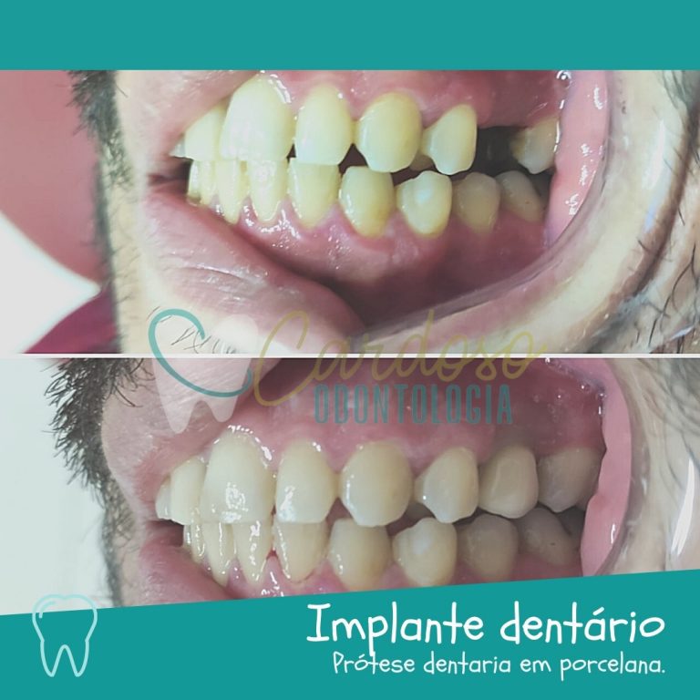 tratamento Implante dentário- Cardoso Odontologia
