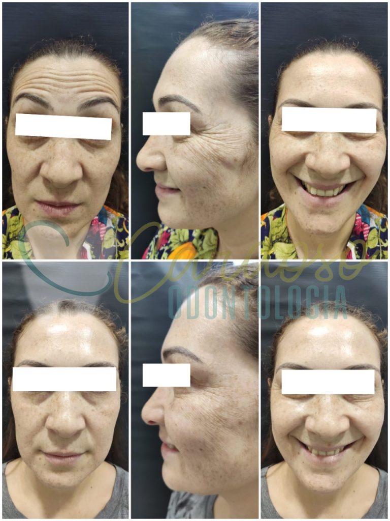 tratamento harmonização facial - Cardoso Odontologia