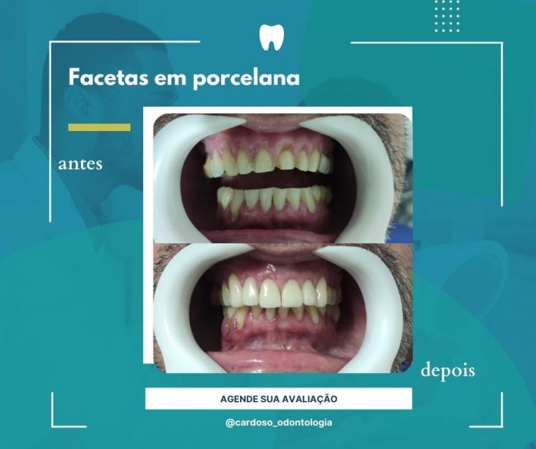 tratamento facetas em porcelana - Cardoso Odontologia