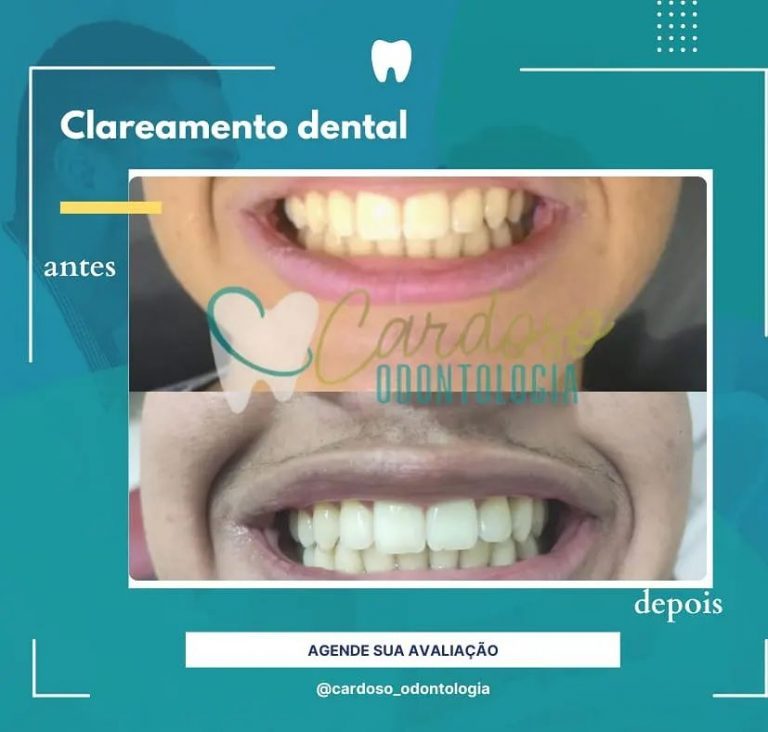 tratamento clareamento dental - Cardoso Odontologia