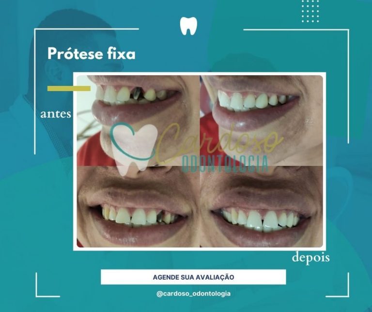 tratamento Prótese fixa - Cardoso Odontologia