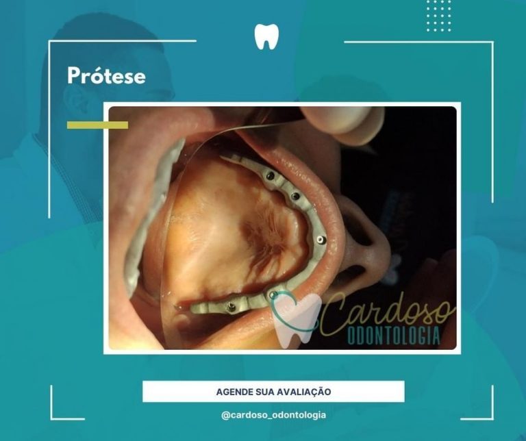 tratamento Prótese - Cardoso Odontologia