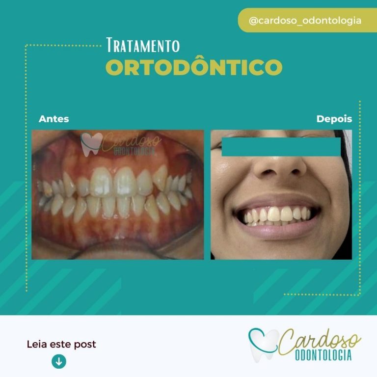 Tratamento ortodôntico