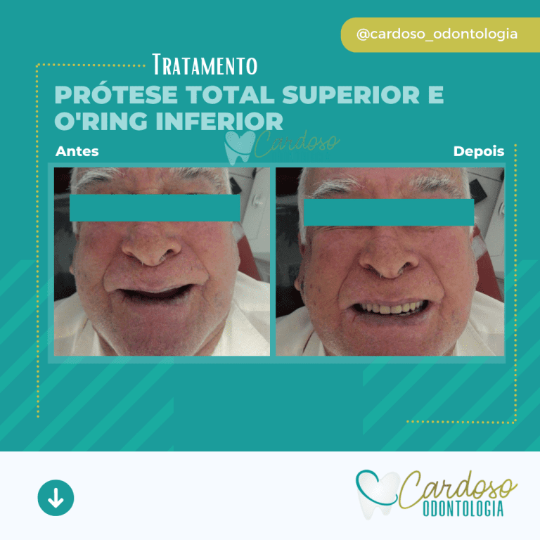 Prótese total superior e o'ring inferior