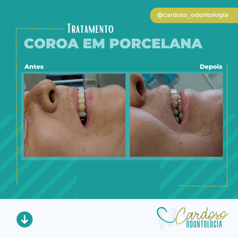 Coroa em porcelana - Cardoso Odontologia